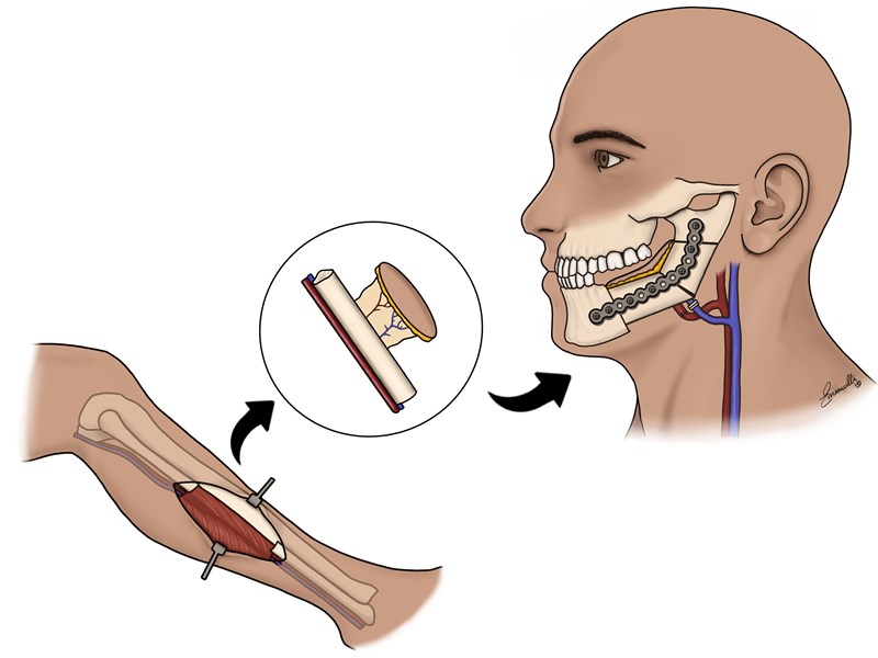 Fibula_Mandible_copy